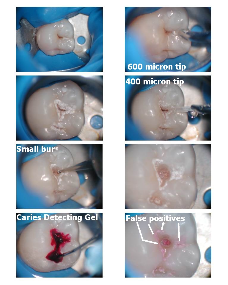 Caries Detector pt1A.jpg